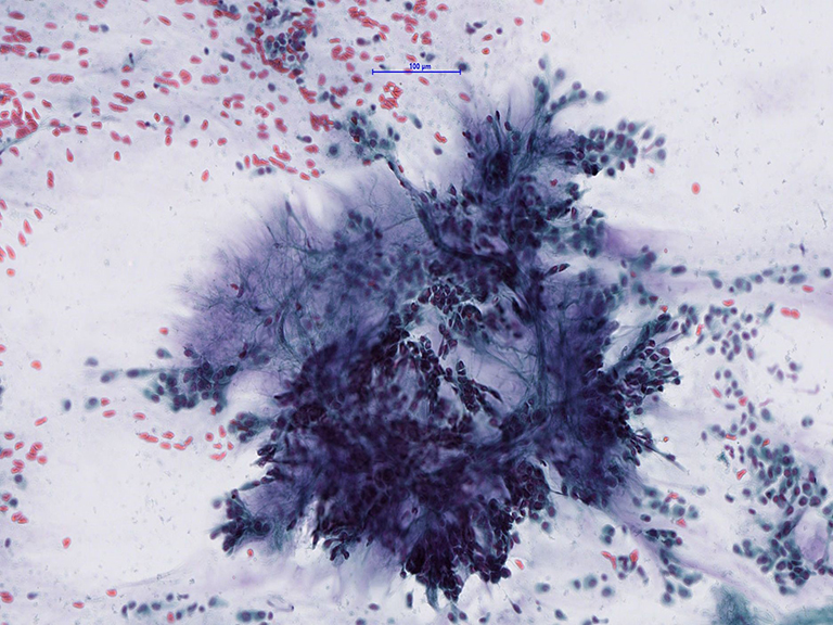 Cytologic examination, image of parotid gland, pleomorphic adenoma